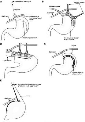 Isoperistaltic gastric tube for long gap esophageal atresia (LGEA) in newborn, infants, and toddlers: a case-control study from a tertiary center